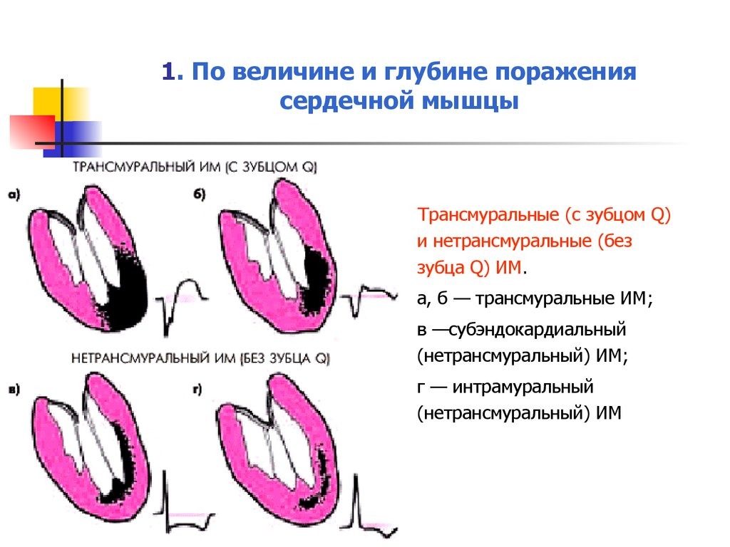 Трансмуральный инфаркт миокарда. Трансмуральный инфаркт миокарда без зубца q. Инфаркт миокарда по глубине поражения. Трансмуральный инфаркт миокарда схема. Глубина поражения при инфаркте миокарда.