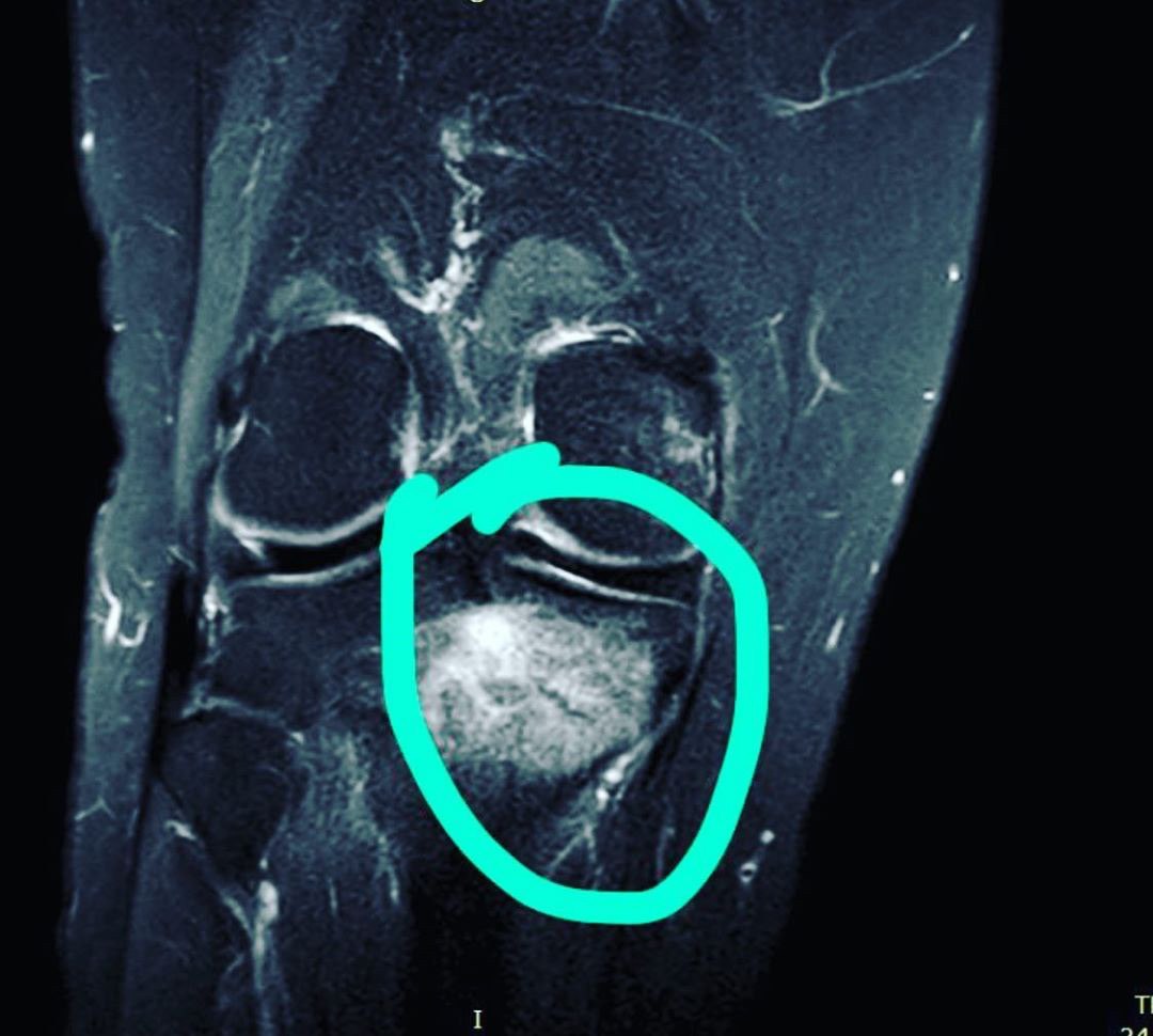 Разрыв рога медиального мениска коленного сустава заднего. Перелом мениска рентген. Разрыв медиального мениска коленного сустава рентген. Мрт разрыв заднего рога мениска. Отрыв корня медиального мениска.