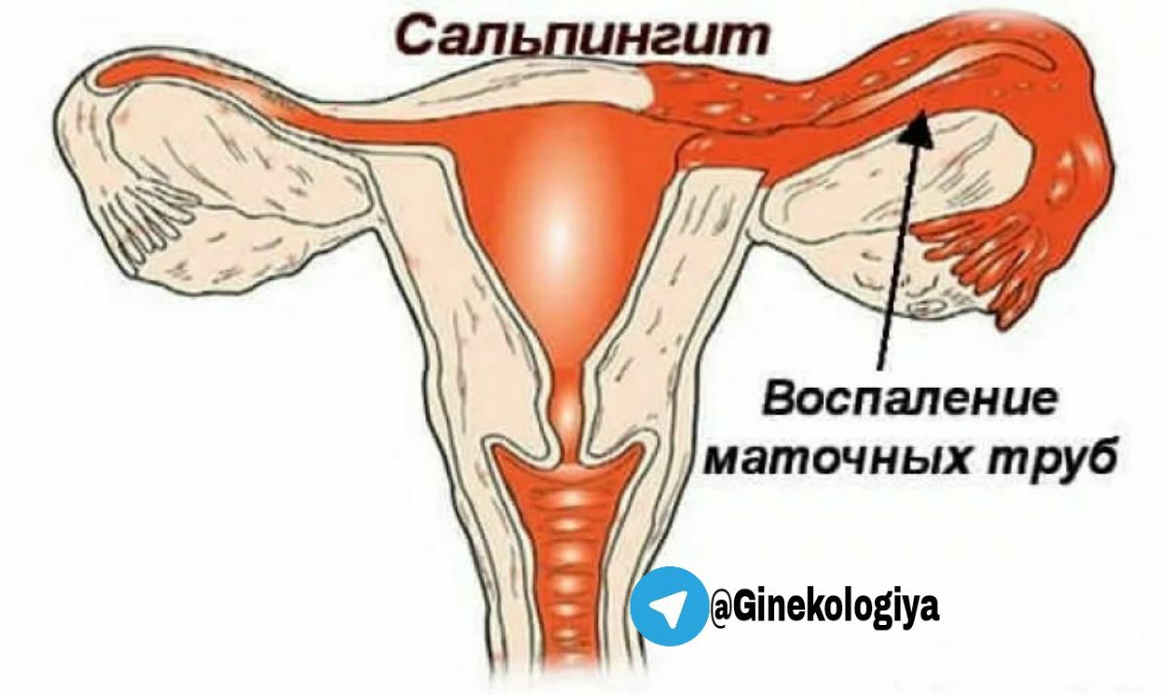 Воспаление придатков отзывы форум. Трихомонадный сальпингит. Гнойный сальпингоофорит.