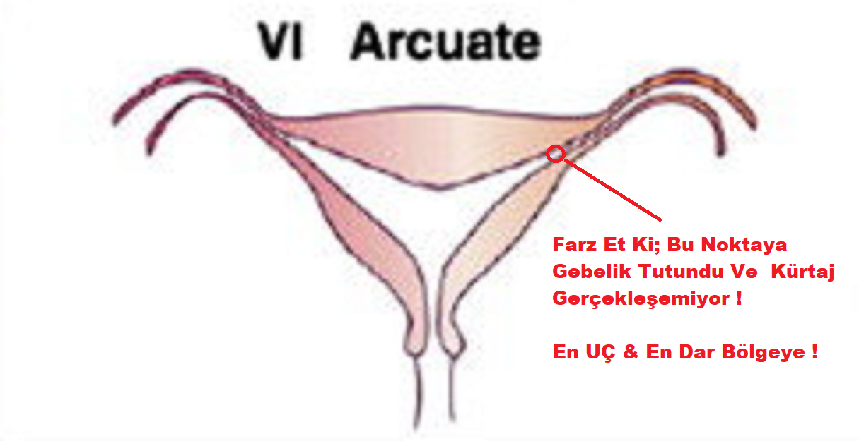 Anomalili uterus, rahmin doğuştan gelen şekil - yapısal anormalliklerine sahip olması durumunu ifade eder. Anormallikler arasında bölünmüş rahim (septum), tek taraflı - çift taraflı rahim yokluğu (agenezis), rahimdeki yapısal deformasyonlar (bicornuate, unicornuate, didelphys), rahim içi yapışıklıklar (Asherman sendromu) gibi durumlar yer alabilir.

Anomalili uterus, Muğla Kürtaj işleminde bazı zorluklara neden olabilir. Özellikle rahim içi yapısal anormallikler, gebelik materyalinin tam alınmasını engelleyebilir. Rahim içindeki bölüntüler -yapısal deformasyonlar, kürtaj sırasında bebeğin , gebelik dokularının tamamen çıkarılmasını zorlaştırabilir. Gebelik materyalinin kısmen , tamamen alınamaması söz konusu olabilir.

Anomalili uterus durumunda, kürtaj işlemine başlamadan önce detaylı değerlendirme yapılması önemlidir. Genellikle ultrasonografi veya diğer görüntüleme teknikleri ile yapılır. Rahimdeki anormalliklerin tipi derecesi belirlendikten sonra, kürtajın ne kadar etkili güvenli olabileceği değerlendirilir.

Bazı durumlarda, anomaliliye sahip uterus nedeniyle kürtaj işlemi yerine alternatif yöntemler tercih edilebilir. Örneğin, rahim içi yapışıklıklar durumunda, yapışıklıkların açılmasında histeroskopi gibi cerrahi müdahaleler gerekebilir. Rahimdeki yapısal anormalliklerin ciddiyetine hastanın durumuna bağlı , bazı vakalarda gebelik sonlandırılması seçeneği kısıtlanabilir diğer gebelik planlama yöntemleri değerlendirilebilir.

Anomalili uterus durumunda, kürtaj , gebelik sonlandırma kararı alınmadan önce jinekolog , üreme sağlığı uzmanıyla detaylı görüşme yapmak önemlidir. Uzman, durumu değerlendirerek size en uygun tedavi seçeneğini sunacaktır.