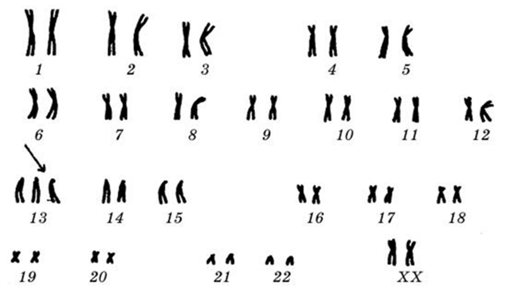 Аномальный кариотип. Кариотип больного с синдромом Патау. Кариотип при синдроме Патау. Синдром Патау кариограмма. Синдром Патау трисомия по 13 хромосоме.