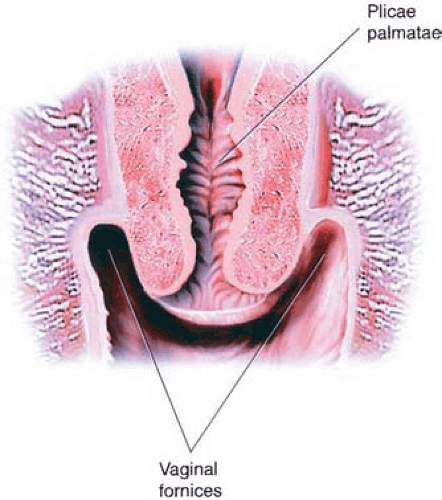 plika palmat, Arbor Vitae Uteri Cervix