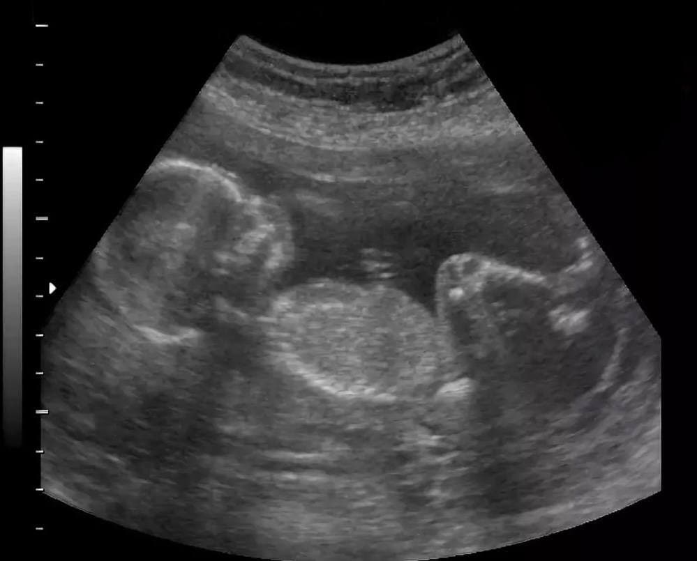 16 неделя 2023. Как выглядит ребенок в 16 недель. Малыш в утробе. Может ли на 16 неделе беременности замереть плод.