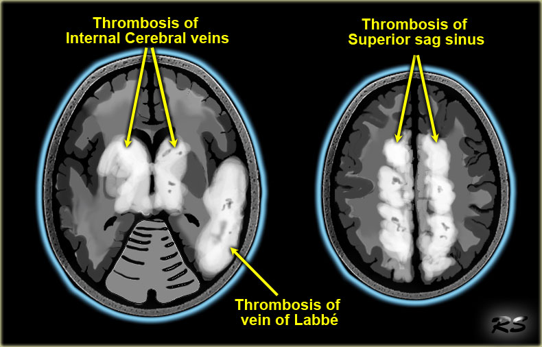 Церебрального тромбоза. Тромбоз сагиттального синуса мрт. Тромбоз синусов головного мозга кт. Венозный тромбоз головного мозга кт.