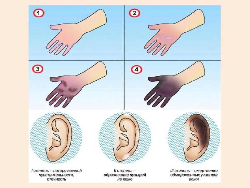 Обморожение признаки