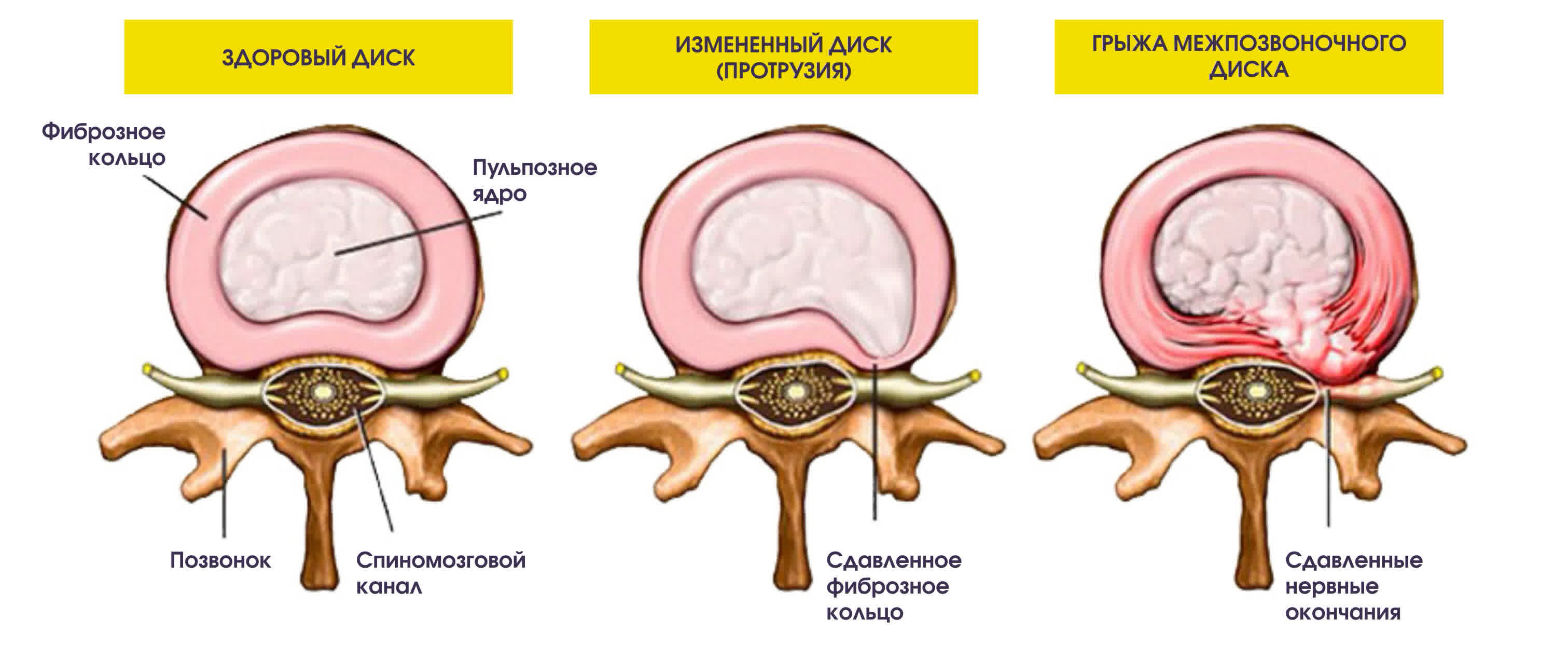 Как действует грыжа позвоночника. Протрузия грыжа межпозвонковых дисков. Фиброзное кольцо и пульпозное ядро протрузия. Грыжа позвоночника схема. Студенистое ядро межпозвоночного диска.