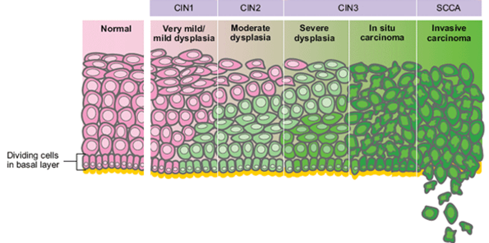 Cin классификация. Гистологическая классификация Cin. Рак in situ шейки