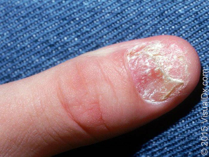 Comparative Study of Clinical and Dermoscopic Features in Nail Psoriasis |  Semantic Scholar