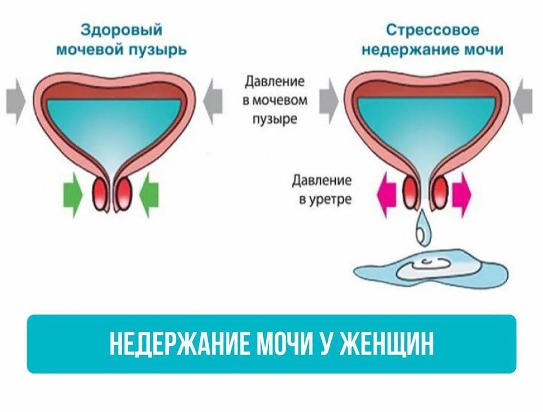 недержание мочи у женщин из за мастурбации фото 4