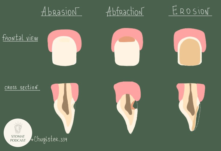 Что такое атриция, абразия, абфракция, эрозия? – Telegraph