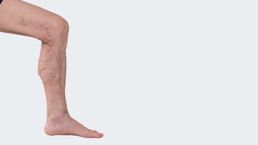 Ciorapi din varice pe picioare cum să alegi - Simptome August