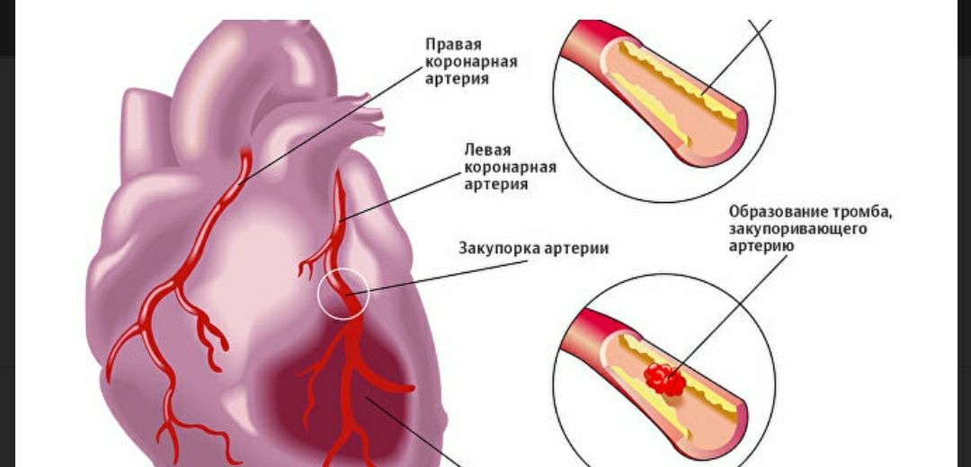 Нестенозирующий атеросклероз брахиоцефальных артерий что это такое. Закупорка коронарной артерии. Эмболия коронарных сосудов. Атеросклеротическое поражение коронарных артерий сердца. Инфаркт миокарда атеросклероз.