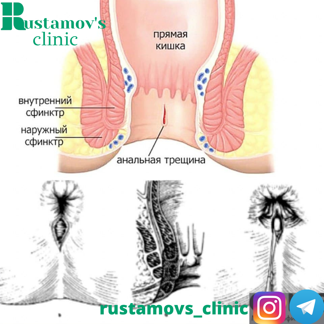 Боли в проходе. Анальная трещина заднего прохода. Геморрой и анальная трещина. Задняя анальная трещина. Анальная трещина у женщин.