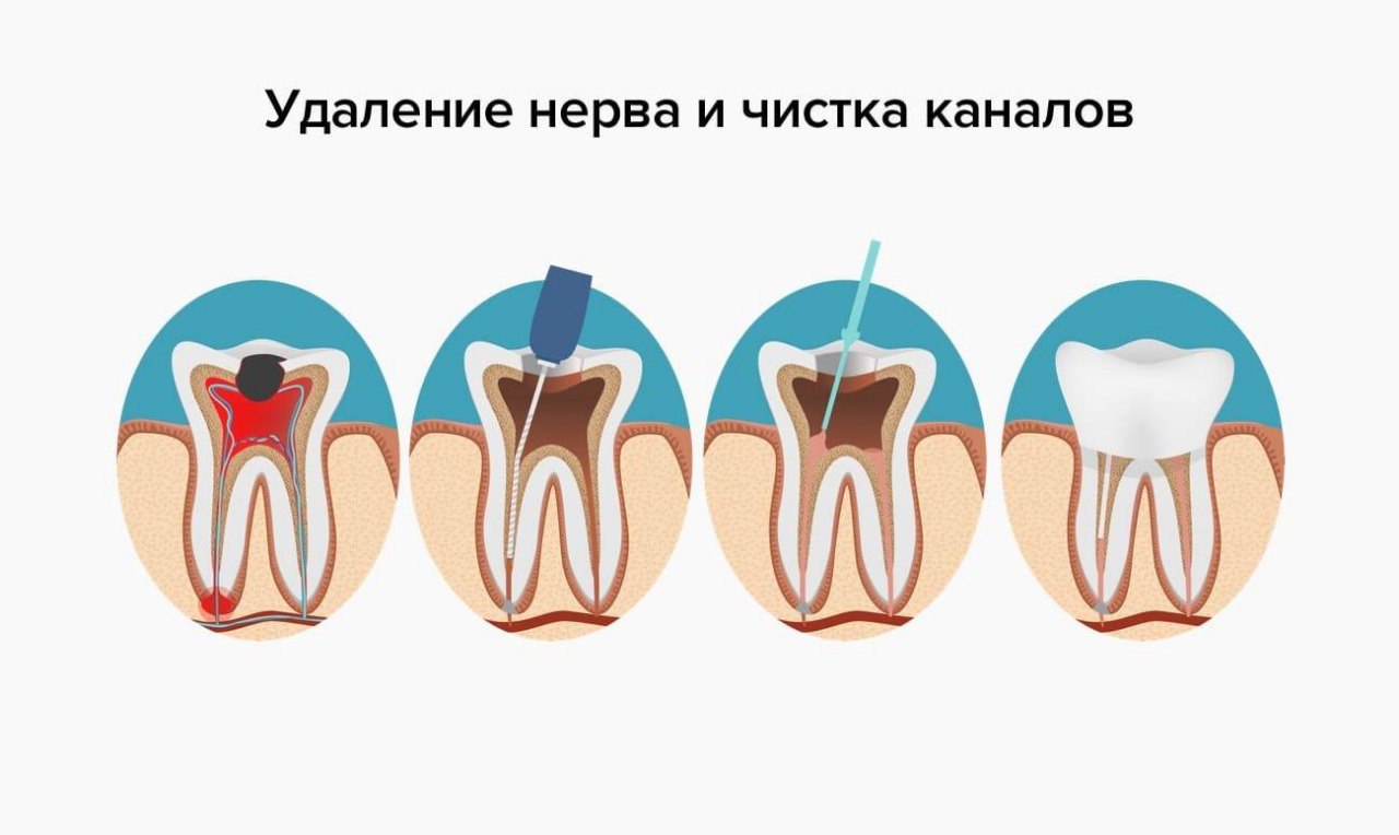 Температура после лечения зуба. Удаление нерва зуба и чистка каналов. Как выглядит удаленный нерв из зуба.