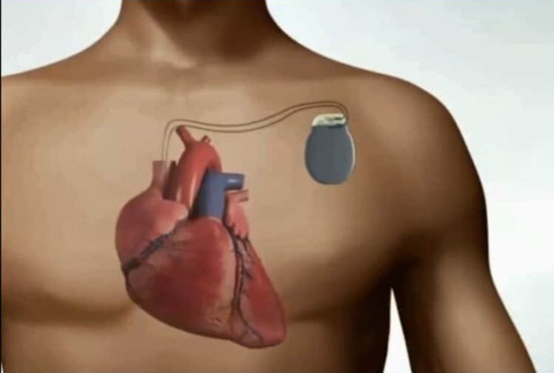 Если стоит кардиостимулятор можно