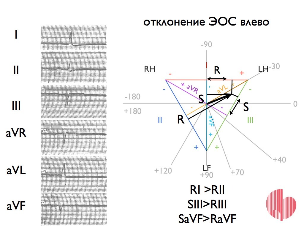 Кто такая эос. Электрическая ось сердца. Оси сердца на ЭКГ таблица. S Тип электрической оси сердца. Электрическая ось сердца таблица.