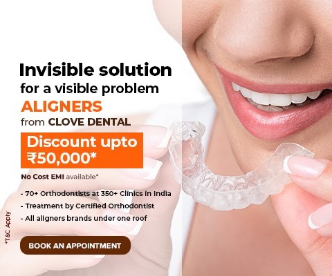 How Much Time is Required for an Invisible Aligner Treatment?