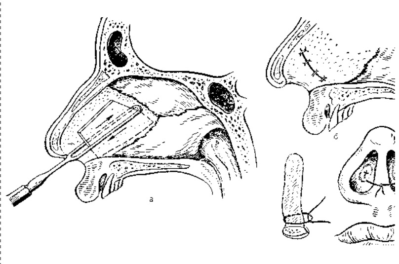 Операция искривление. Операция подслизистая резекция носовой перегородки. Подслизистая резекция перегородки по Киллиану. Септопластика, подслизистая резекция носовой перегородки. Подслизистая резекция носовой перегородки по Киллиану техника.