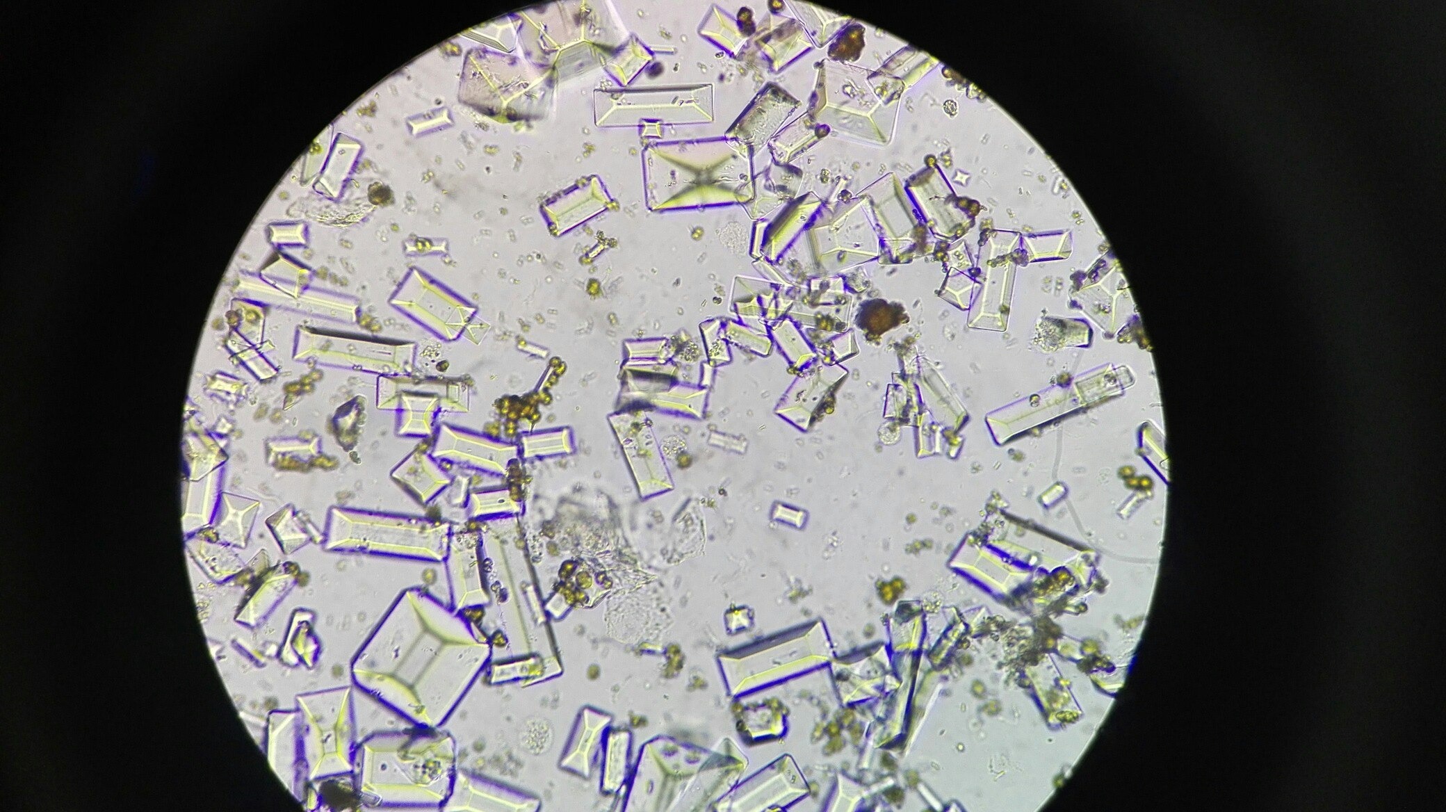 Высокая соль в моче. Микроскопия мочи трипельфосфаты. Нечипоренко микроскопия. Струвиты микроскопия. Кристаллы оксалата кальция микроскопия.