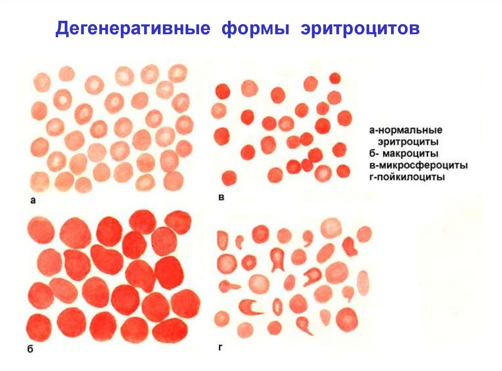 На рисунке изображены эритроциты. Патологические формы эритроцитов. Дегенеративные формы эритроцитов при анемиях. Формы эритроцитов преобладающие в крови. Формы эритроцитов седловидный.