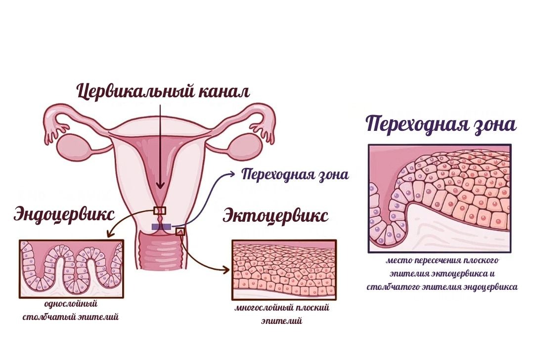 Аденокарцинома шейки матки. – Telegraph