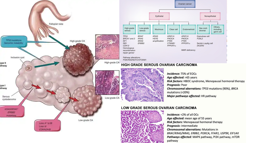 Карцинома low grade мочевого. Low Grade в онкологии. Grade 2 в онкологии что это. Серозная карцинома Low Grade яичников.