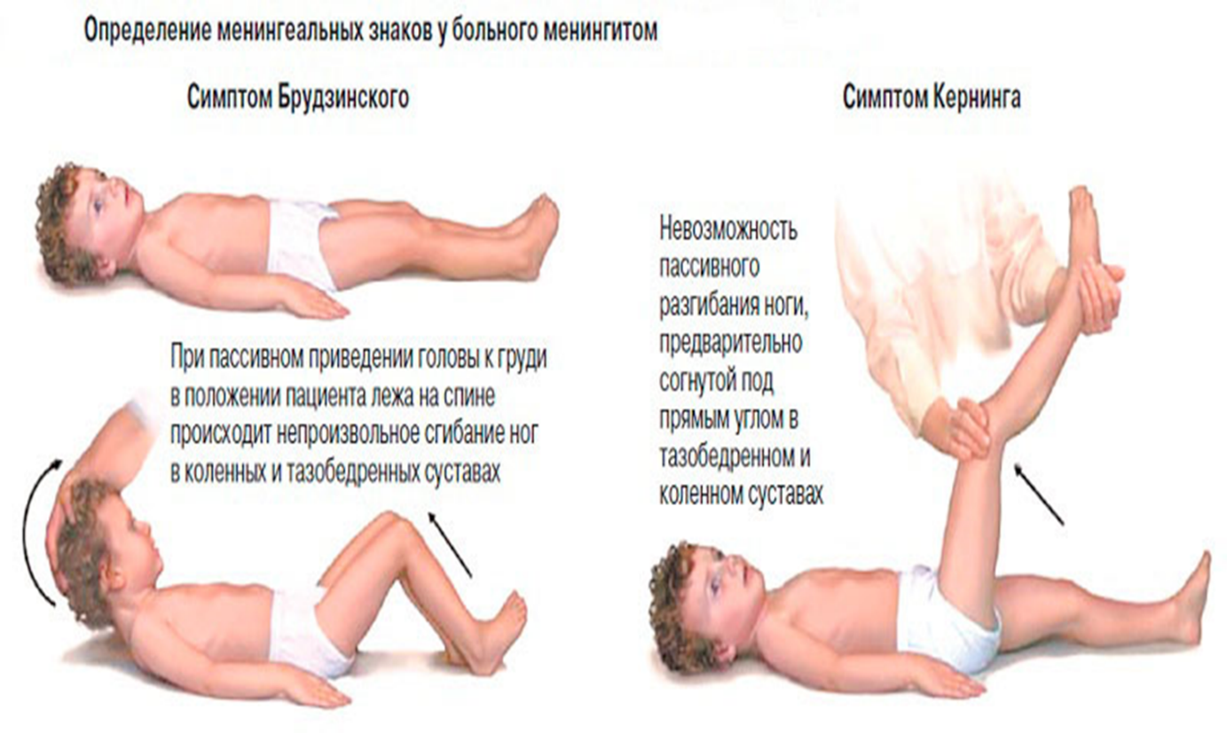 Энтеровирусный менингит симптомы. Симптом Кернига и Брудзинского. Менингококковый менингит геморрагическая сыпь.