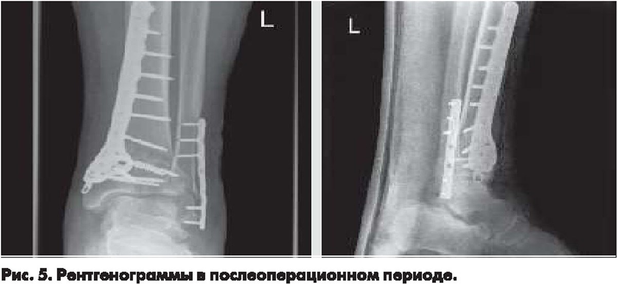 Дистальный перелом большеберцовой кости. Остеосинтез пилона пластинами. Перелом края большеберцовой кости.
