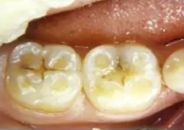 Что такое атриция, абразия, абфракция, эрозия? – Telegraph