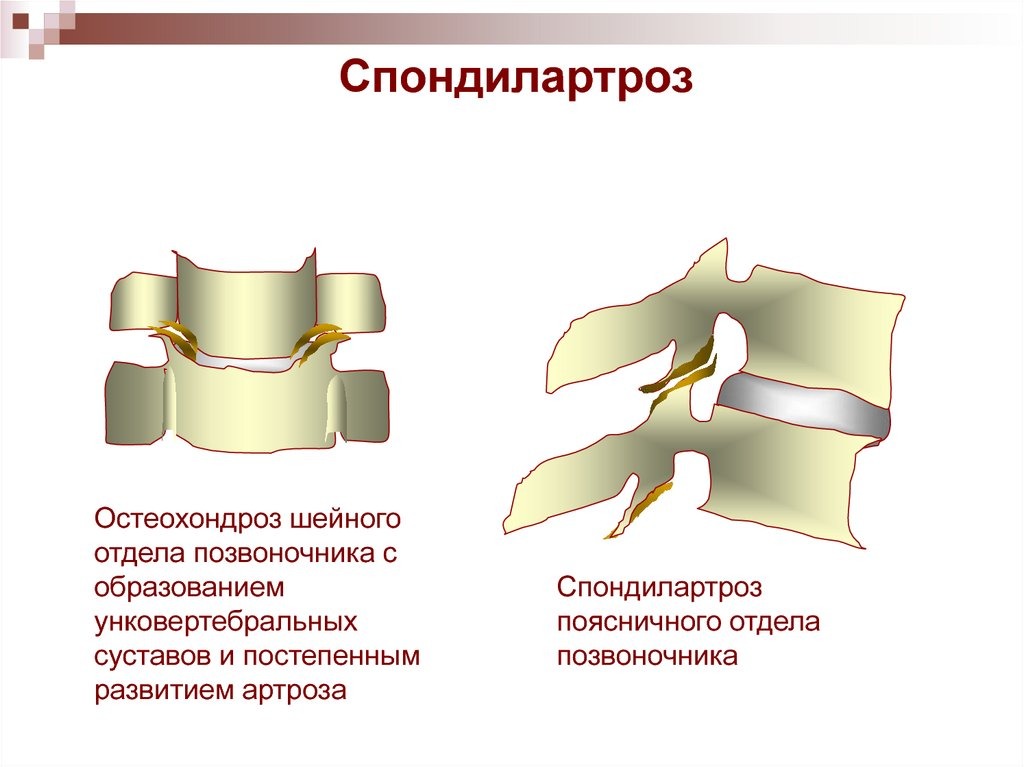 Суставы позвоночника. Унковертебральные сочленения / сустав Люшка. Унковертебральные сочленения шейного отдела позвоночника. Унковертебральный сустав шейного отдела позвоночника. Артроз унковертебральных сочленений шейного отдела рентген.