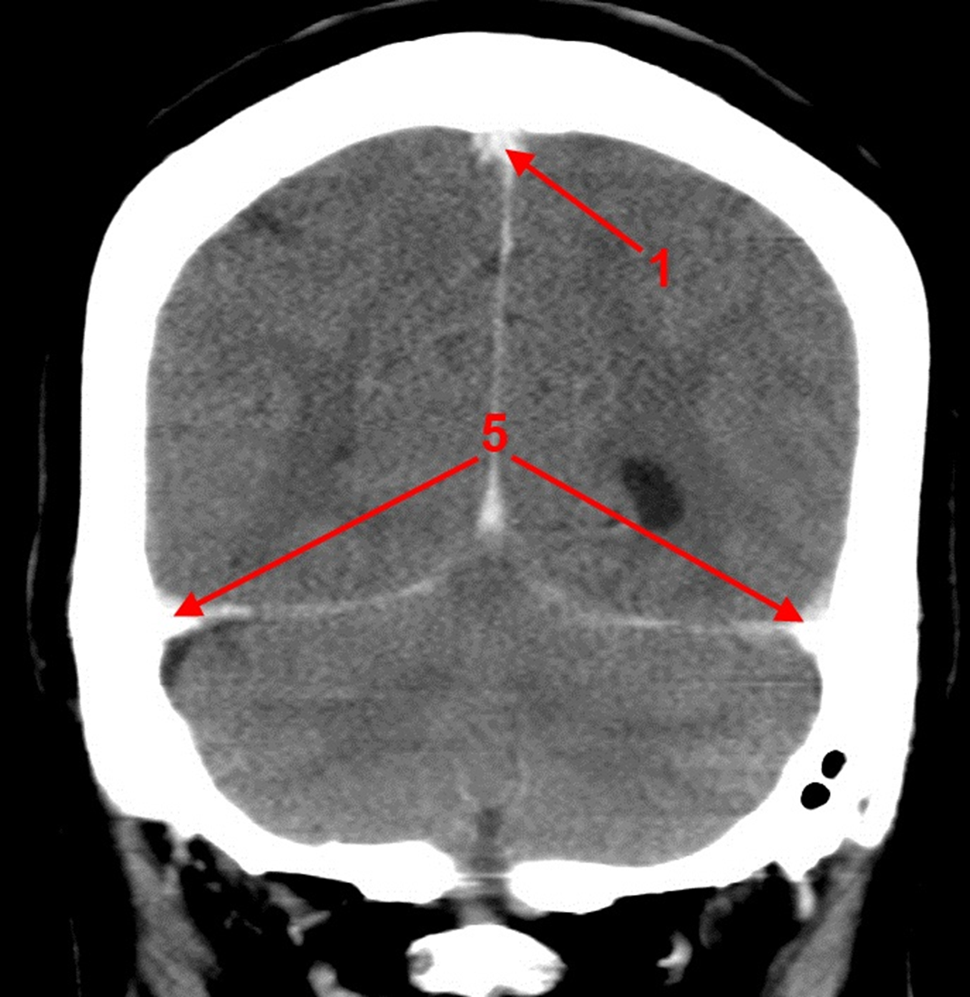 Тромбоз синусов головного мозга кт. Синус тромбоз сагиттального синуса кт. Тромбоз сагиттального синуса на кт. Тромбоз сигмовидного синуса на кт. Мрт тромбоз