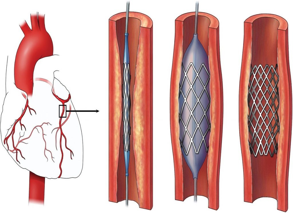 Баллонная коронарная ангиопластика. Коронарное стентирование сосудов сердца. ЧКВ баллонная ангиопластика. Баллонная ангиопластика и стентирование артерий сердца.
