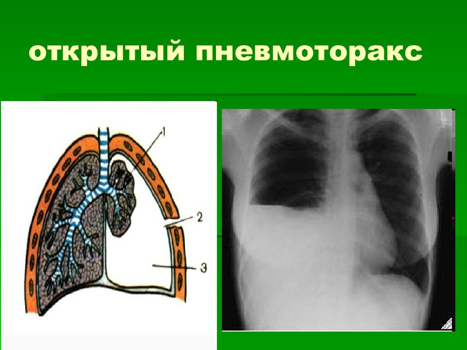 Закрытый пневмоторакс это