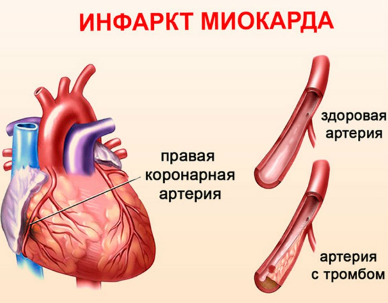 ИНФАРКТ МИОКАРДА – Telegraph