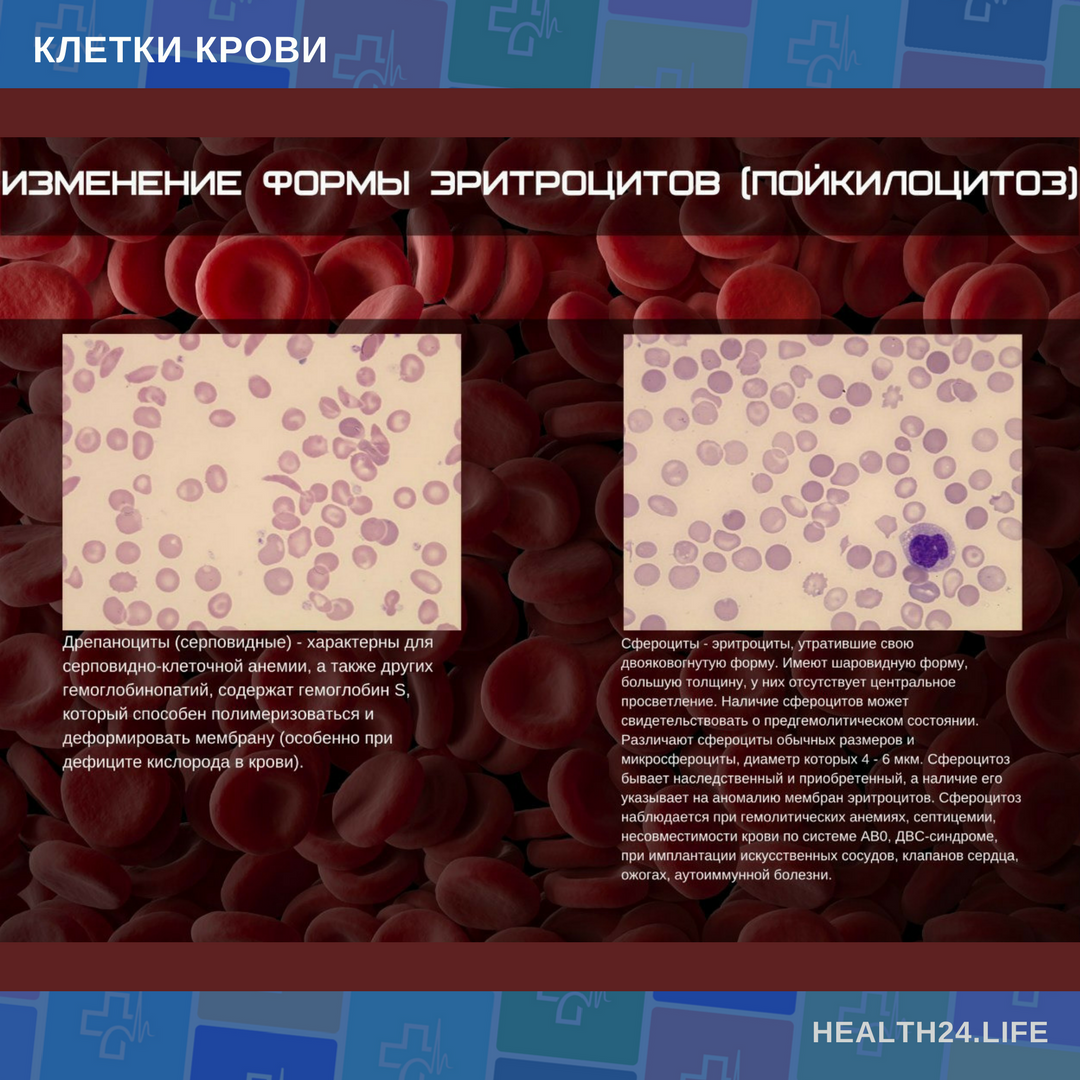 Изменение клеток крови. Изменение формы эритроцитов. Клетки крови при анемии. Клетки крови эритроциты. Изменение клеток крови при анемиях.