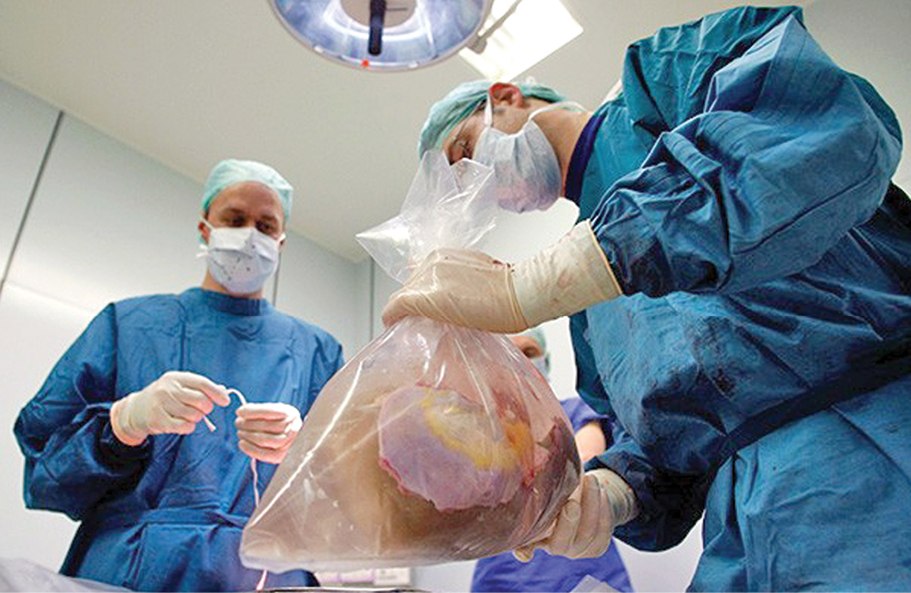 Пересадку органов в Хабаровске возобновят этим летом
