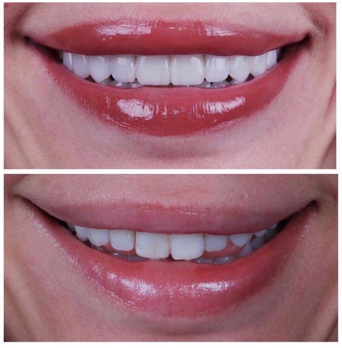 Виниры: вопросы и ответы?