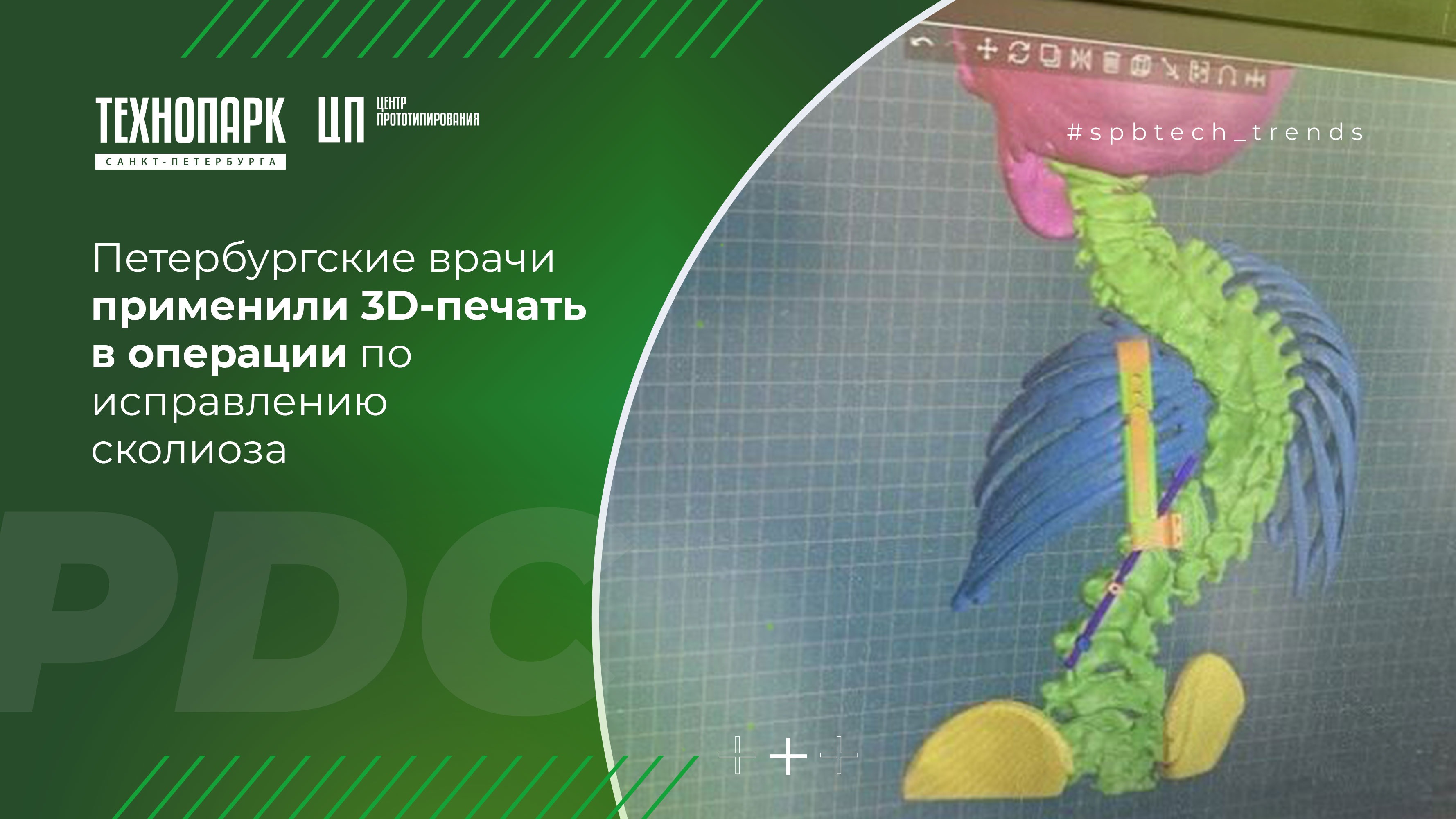Петербургские врачи применили 3D-печать в операции по исправлению ...