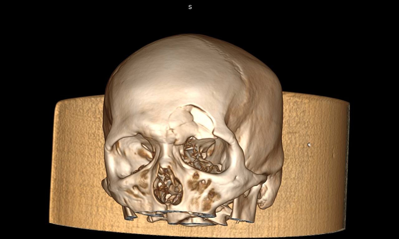 Хабаровские врачи восстановили пациенту череп