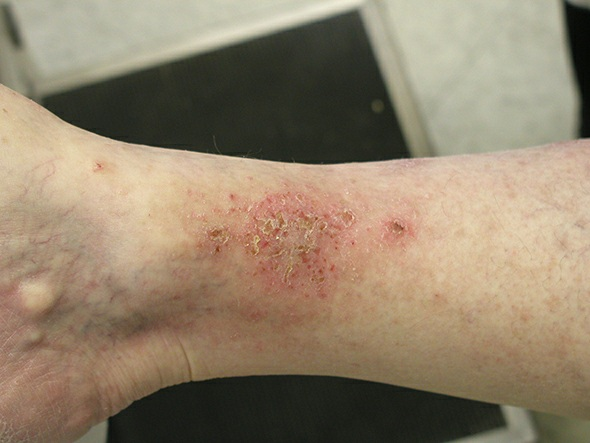 Нуммулярная (монетовидная) экзема – Telegraph