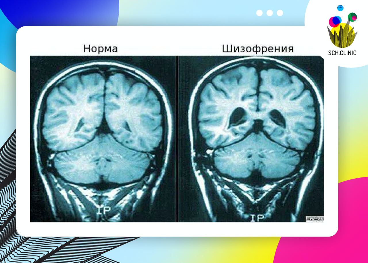 Мозг здорового человека и человека с шизофренией. Головной мозг при шизофрении. Изменения мозга при шизофрении. Черная субстанция мозга. Мозг больного шизофренией.