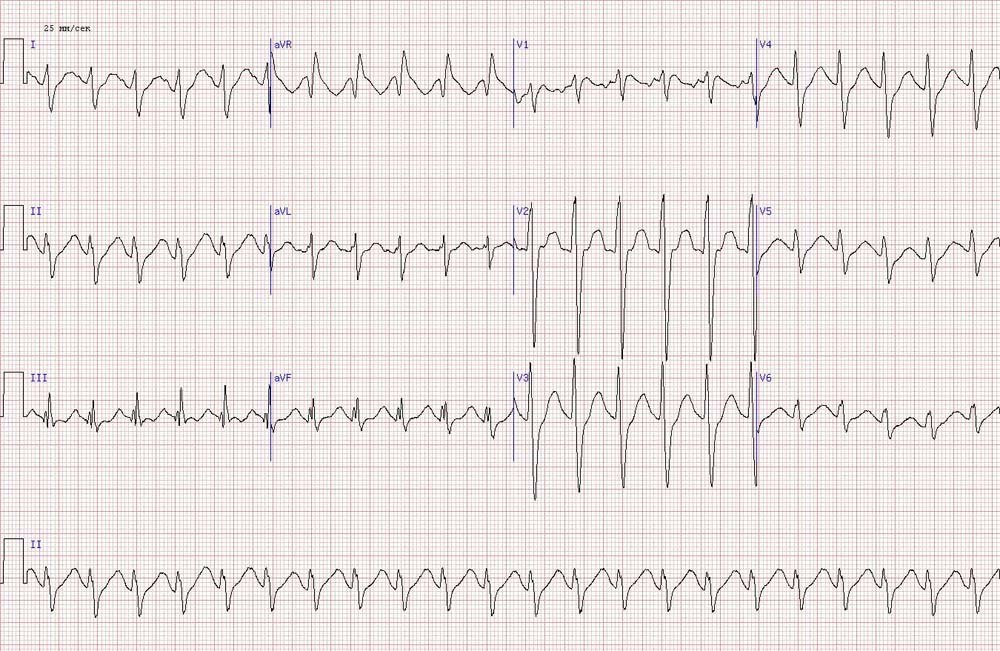 Тахикардия на экг