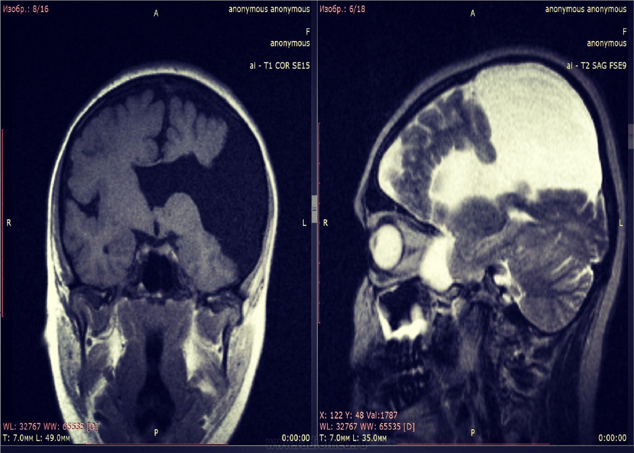 Шизэнцефалия мрт картинки