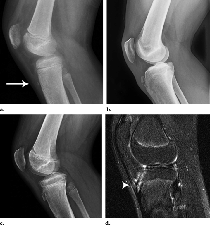 Остеохондропатия Осгуда-Шляттера – Telegraph