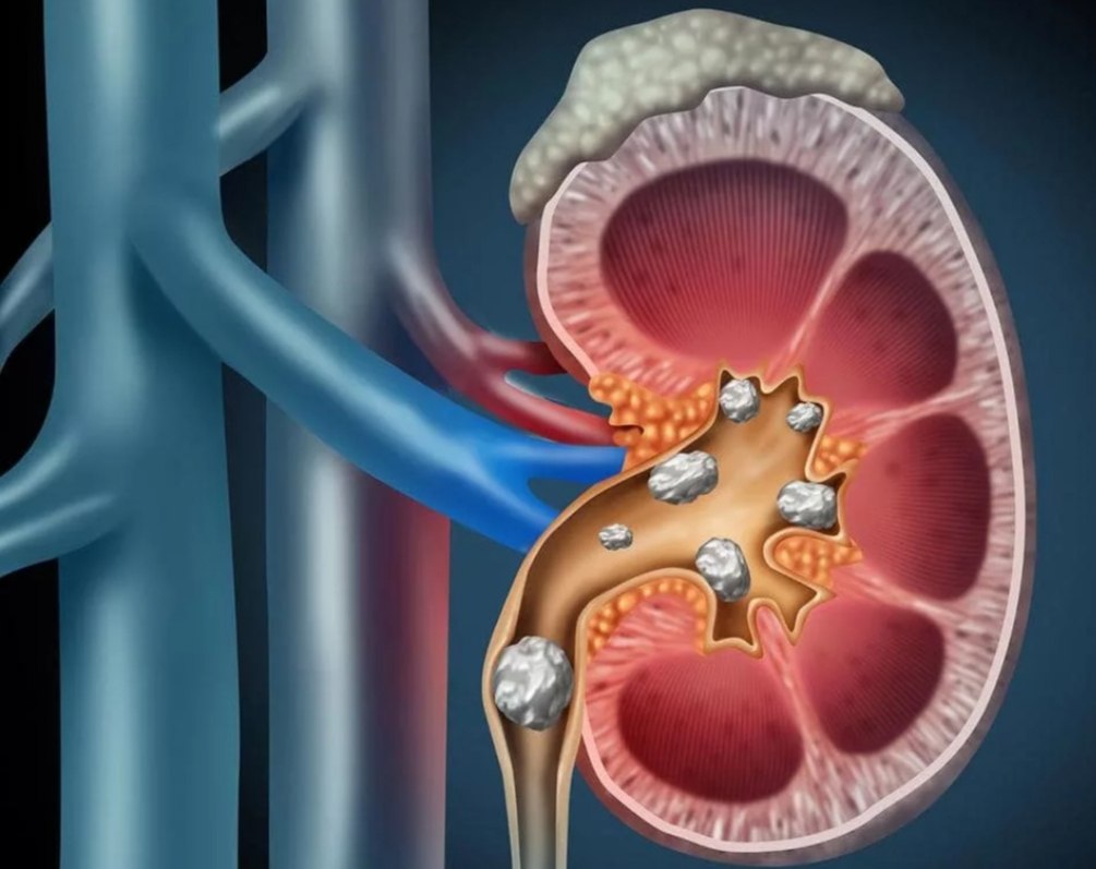 Конкременты в почках