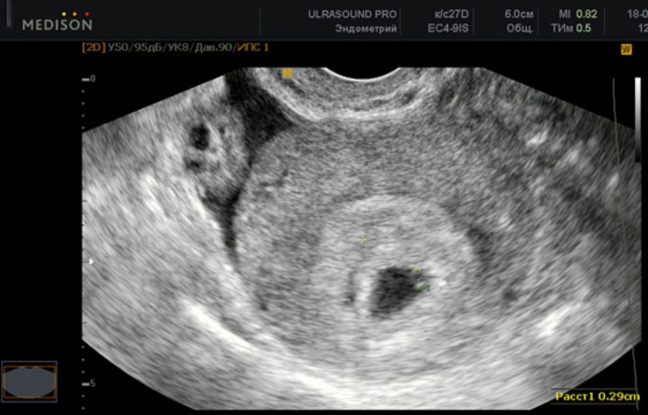 Беременность 4 недели видна на узи. УЗИ 4 недели беременности. УЗИ на 4 акушерской неделе беременности. Фото УЗИ беременности 4 недели. Снимок УЗИ на 4 неделе беременности.