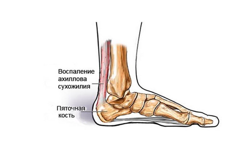 Пяточный тендинит. Воспаление ахиллова сухожилия. Ахиллово сухожилие на стопе. Симптомы тендинита ахиллова сухожилия. Тендинит сухожилия голеностопного сустава.