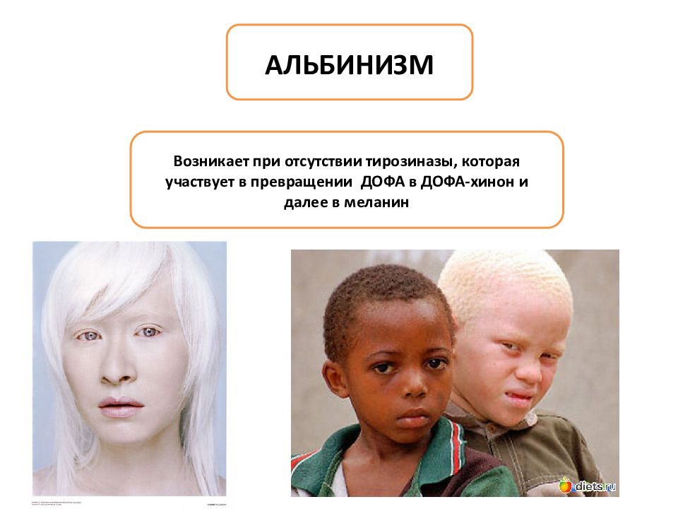 Альбинизмом страдают. Альбинизм Тип наследования. Альбинизм кариотип. Наследственная болезнь альбинизм. Причины заболевания альбинизма.