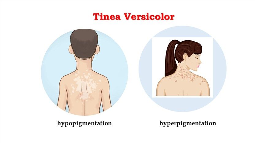 Tinea versicolor (ie, pityriasis versicolor) is a common superficial fungal  infection. Patients with this disorder often present with hypopigmented,  hyperpigmented, or erythematous macules on the trunk and proximal upper  extremitie. – Telegraph
