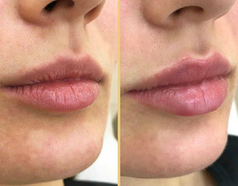 Контур губ гиалуроновой кислотой до и после фото